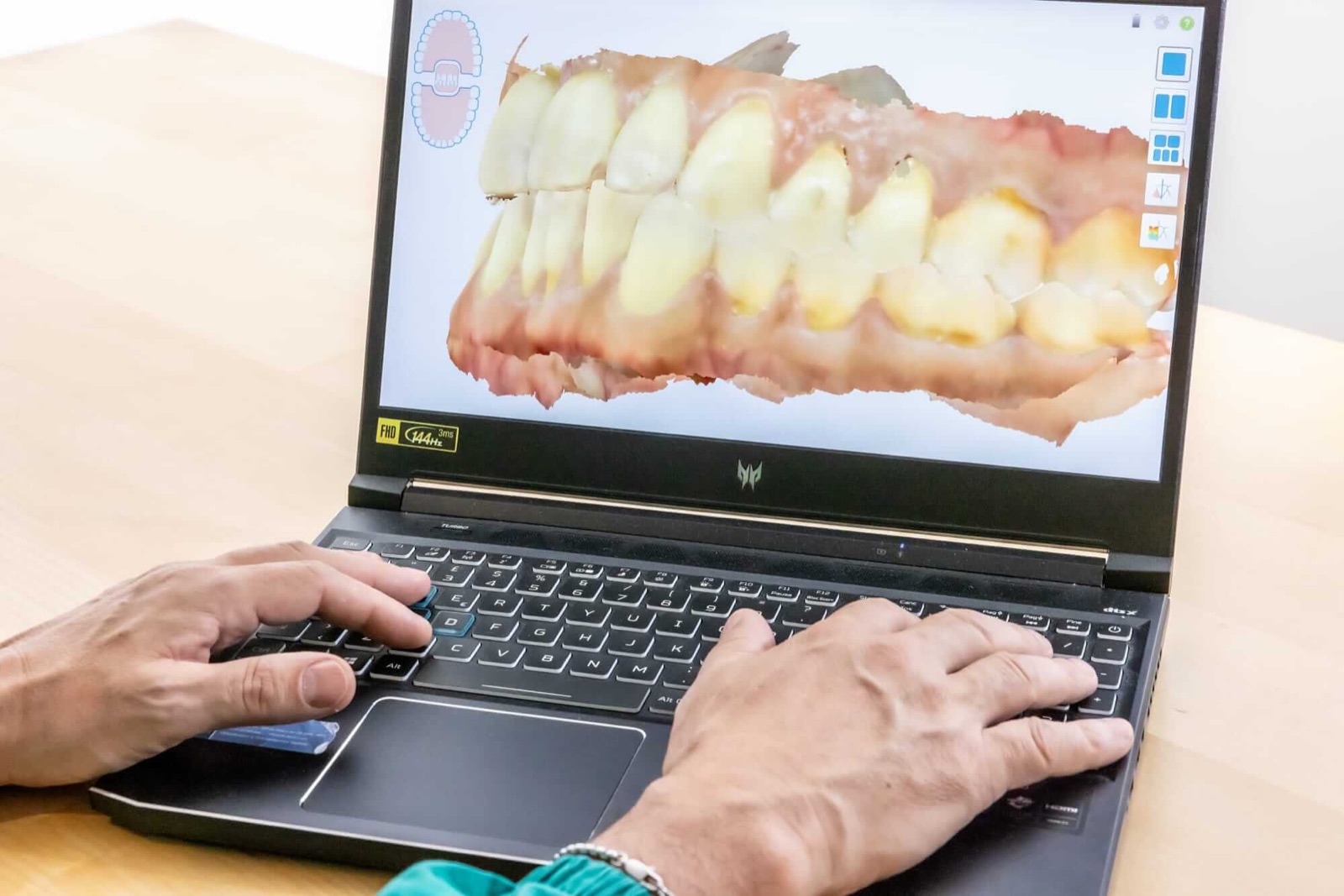 Un modello digitale dei denti sullo schermo del computer